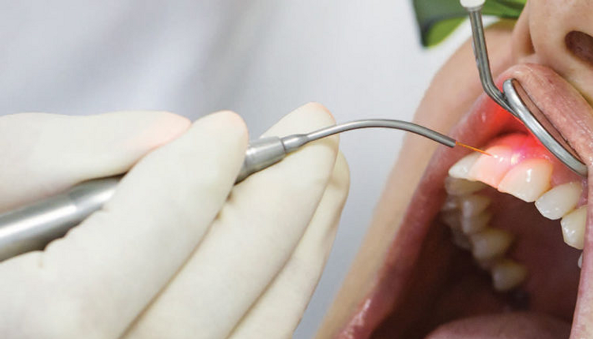 Soft Tissue Laser - Romsey Dental
