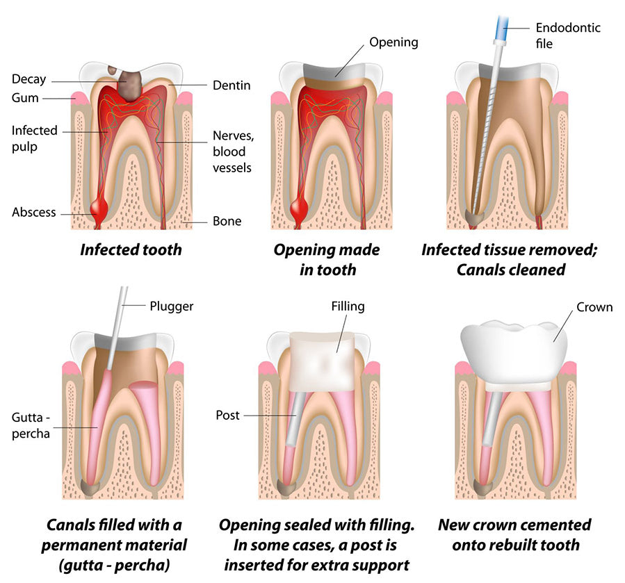 Root Canal Treatment - Romsey Family Dental Care